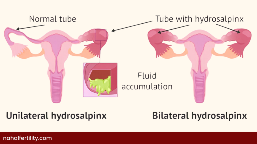 When both fallopian tubes are blocked, known as bilateral hydrosalpinx, the chances of natural conception are nearly zero